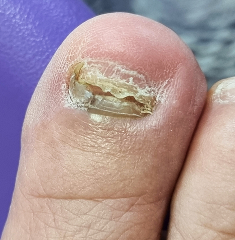 Toenail Fungus